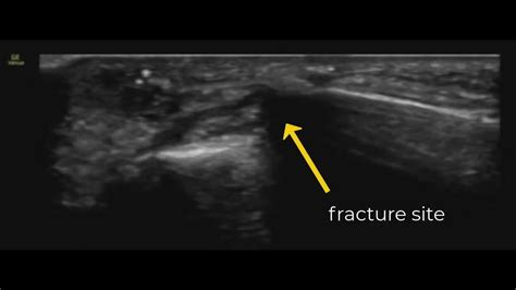 Metacarpal Fracture Reduction, Ulnar Nerve Block, guided by #POCUS ...