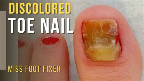 Discolored Nail Cleaning and Cutting *** Discolored Nail*** Full Treatment By Miss Foot Fixer ...