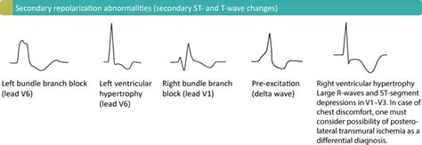 T-waves in ischemia: hyperacute, inverted (negative), Wellen's sign ...