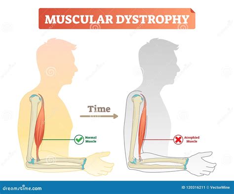 Dystrophin Muscle Protein Domain (N-terminal Actin Binding Domain ...