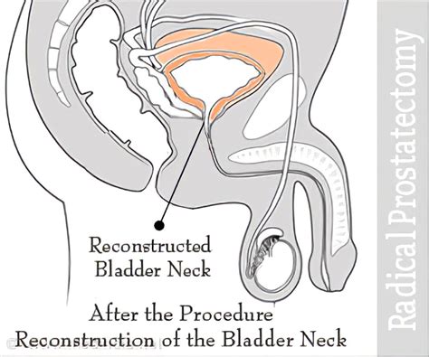 Radical Prostatectomy - Types, Tests, Procedure, Complications