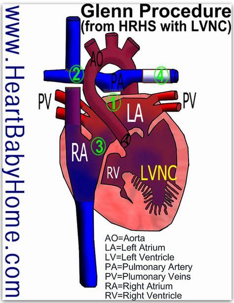 11 Glenn Procedure ideas in 2021 | congenital heart defect, congenital ...