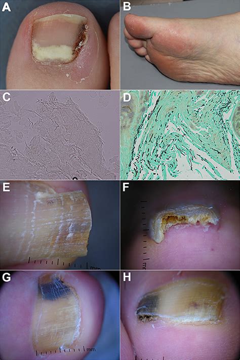 Frontiers | Diagnosis of Onychomycosis: From Conventional Techniques and Dermoscopy to ...