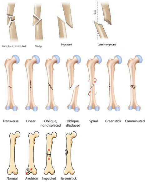 Fracture Types | Orthopedic nursing, Medical, Medical education