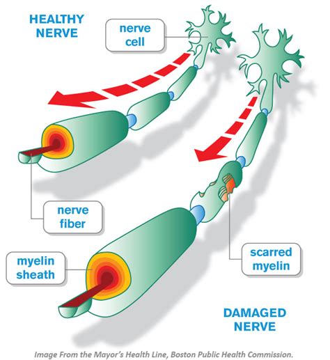 What is Multiple Sclerosis (MS)? | Shield HealthCare