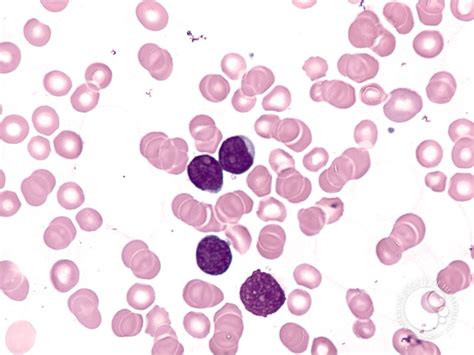 ALL - Peripheral Smear - 1.