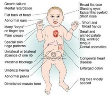 DiGeorge Syndrome - Pediatrics at Best