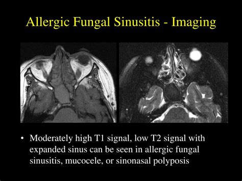 PPT - Fungal Sinusitis: An Overview PowerPoint Presentation, free download - ID:343185