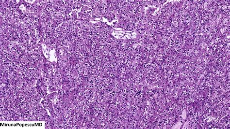 Clear cell renal cell carcinoma with rhabdoid and sarcomatoid features ...