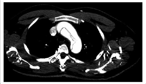 CT angiography showed aortic dissection involving the aortic arch ...