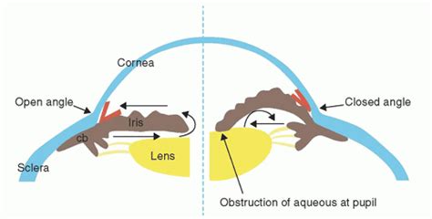 Angle Closure Glaucoma | Anesthesia Key