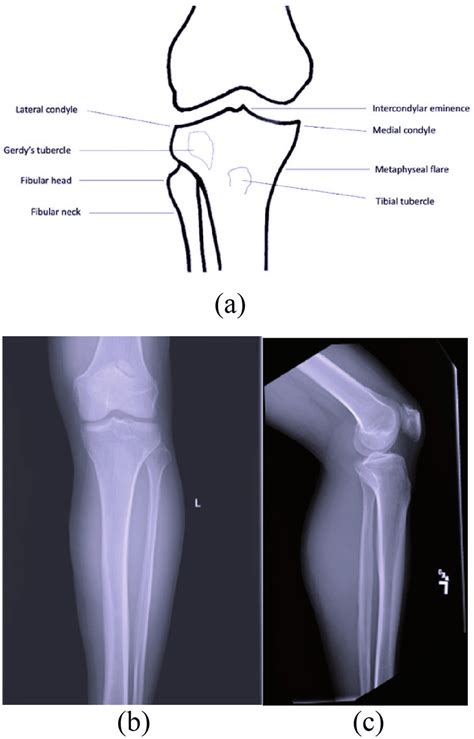 Anatomy Of Tibial Plateau | Images and Photos finder