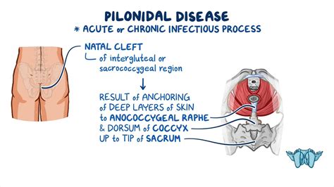 Pilonidal Disease