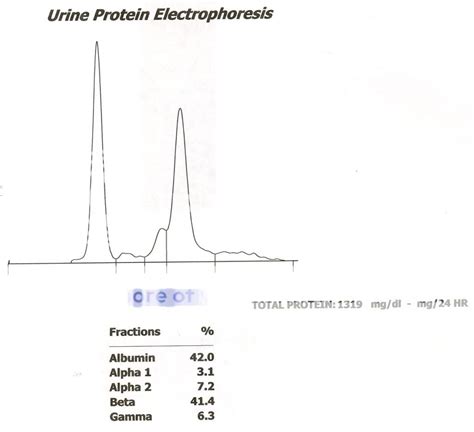 Urine Protein Electrophoresis Photo by labdoc | Photobucket