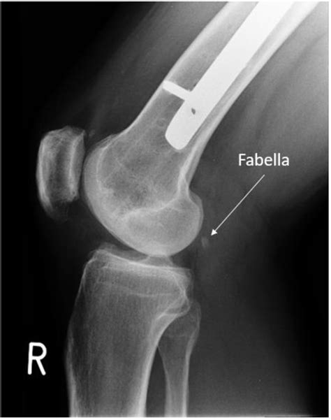 Fabella Syndrome Following De-Rotation Surgery to Correct a Femoral ...