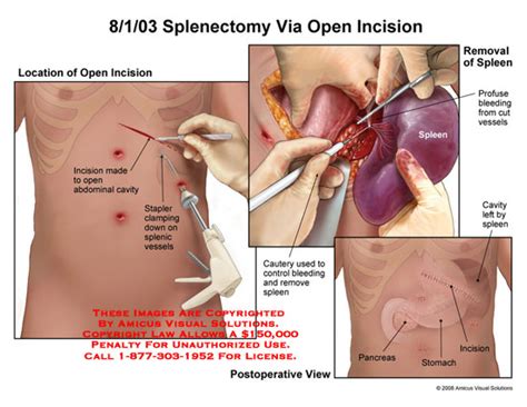 AMICUS Illustration of amicus,surgery,splenectomy,spleen,removed,removal,open,incision,bleeding ...