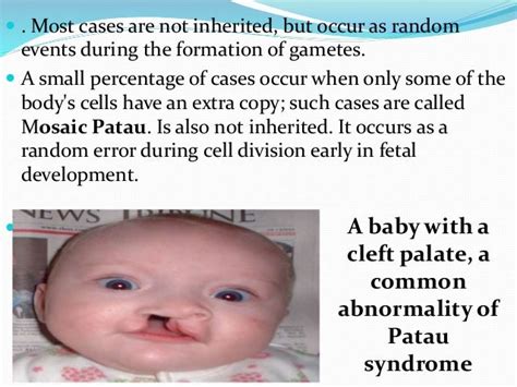 Patau syndrome