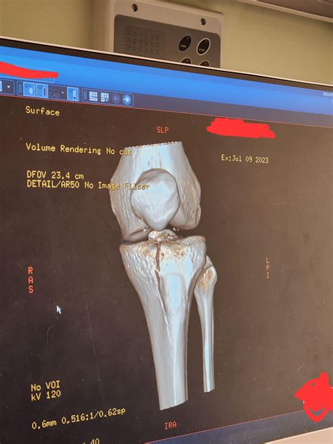 tibial plateau fracture. happened 1 week ago, finally got my consult ...