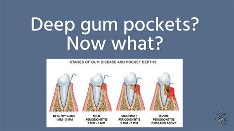 Deep gum pockets | Tim Chauvin Dental Lafayette La