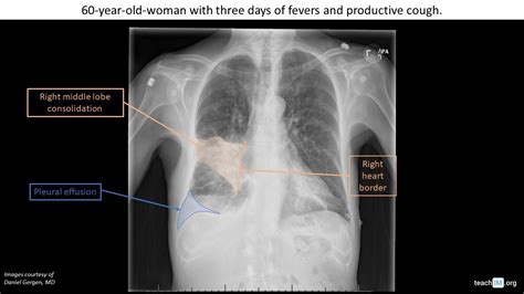 Right Upper Lobe Pneumonia