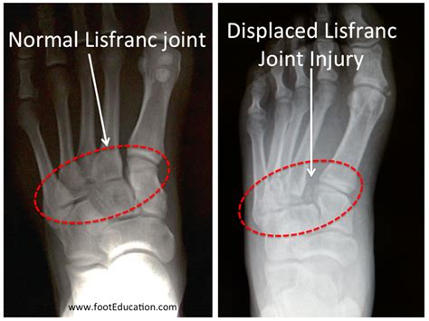 Lisfranc Injury - FootEducation