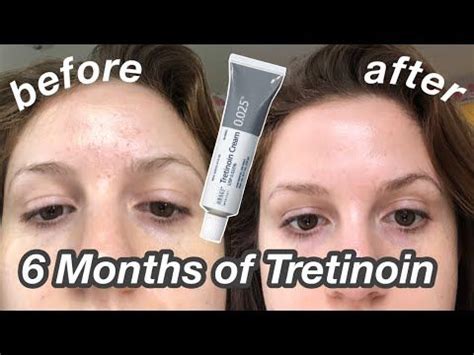 6 Month Tretinoin/Retin-A Update: Before & After + My Current Skincare ...