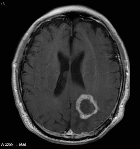 Radionecrosis - ring enhancing | Radiology Case | Radiopaedia.org | Radiology, Mri brain, Brain ...