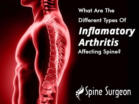 What Are The Different Types Of Inflammatory Arthritis - Design Talk