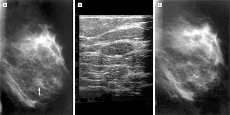 Diagnosis and Treatment of Breast Fibroadenomas by Ultrasound-Guided ...