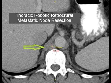 Trans-thoracic Robotic Retrocrural Metastatic Lymph Node Resection - YouTube