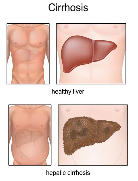 What is Caput Medusae? (with pictures)