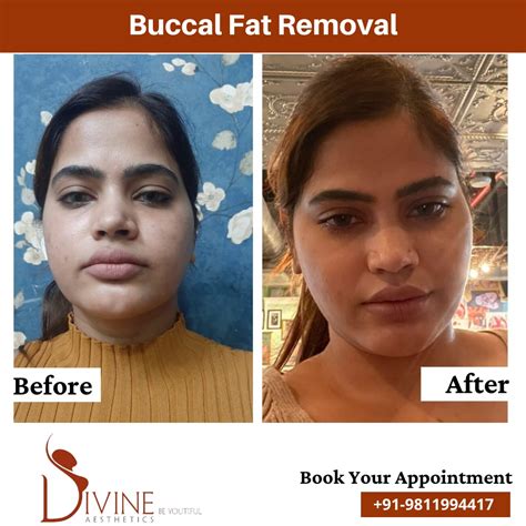 Face Fat Removal Surgery Shop | varsana.com