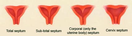 Uterine septa | Centre IÉNA Gynécologie Obstétrique (I. GO)