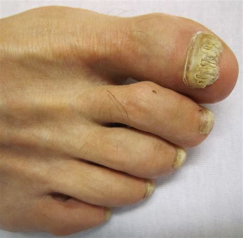 Toenail Fungus - SouthEast Podiatry