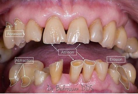 Difference between dental attrition, abfraction, erosion and abrasion | Dental decay, Dental ...