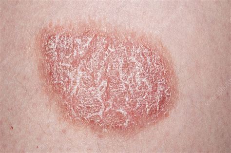 Plaque psoriasis on the skin - Stock Image - C011/7475 - Science Photo Library