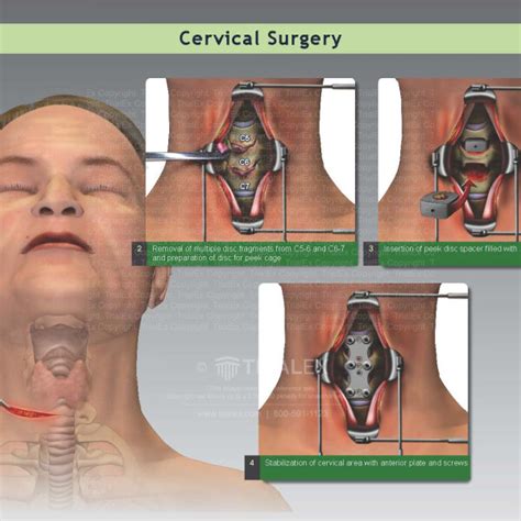 Cervical spine surgery - googlesay