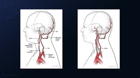 #169: Subclavian Artery to Internal Carotid Artery Interpositional ...