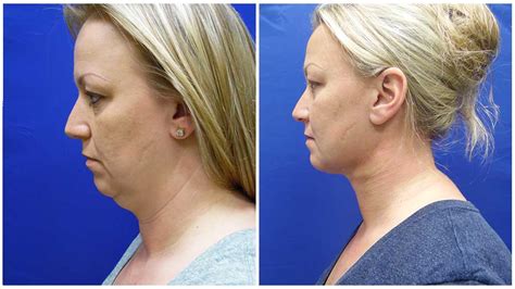 Chin Liposuction Milwaukee - Milwaukeeliposuction.com