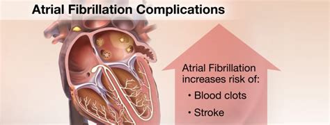 Atrial Fibrillation Complications – Medmovie.com