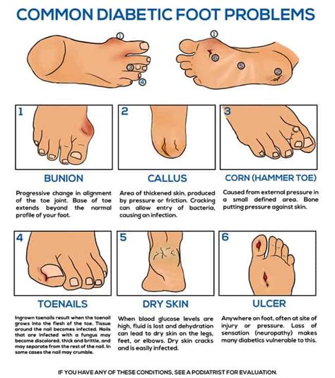 Life Expectancy After Diabetic Foot Amputation - DiabetesWalls