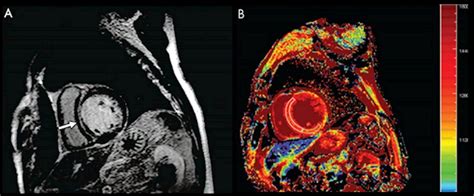 Could cardiac MRI screen for heart disease?