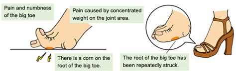 Pain and numbness of the big toe | KASAHARA FOOT CARE