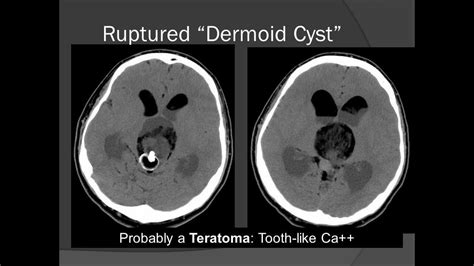 33+ Pineal Gland Cyst Removal | Muldede