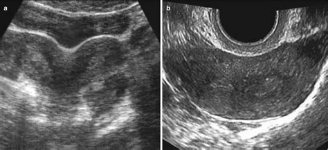 Congenital Uterine Anomalies | Radiology Key