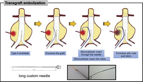 Transgraft embolization by using long needle for the treatment of type ...