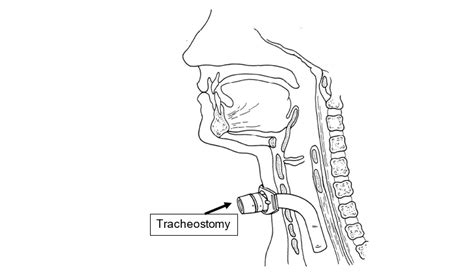 Tracheostomy Clip Art