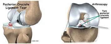 ACL and PCL Reconstruction Surgery at Rs 240000 in Nagpur | ID: 10737878033