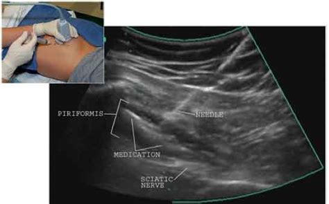 Piriformis Syndrome Treatment | Sciatica Pain Treatment