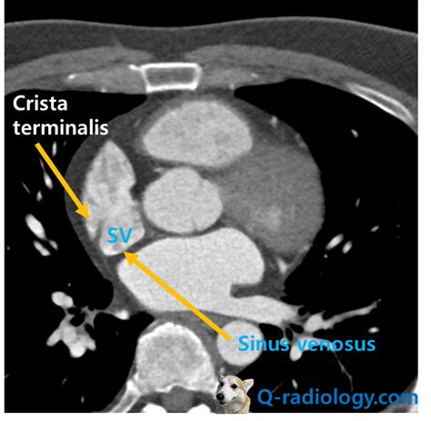 Bands In The Heart : Crista Terminalis - Q-radiology